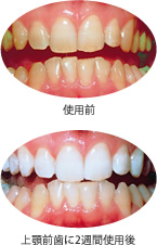 ホワイトニング(使用前、使用後)
