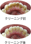 ホワイトニング(クリーニング前、クリーニング後)